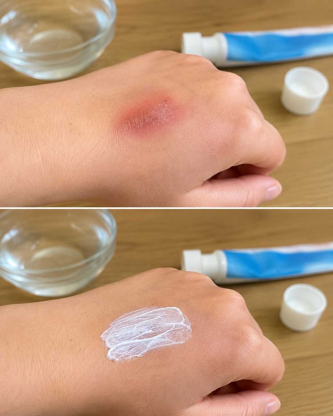 Dentifrice sur une petite brûlure : pourquoi cette astuce populaire est déconseillée